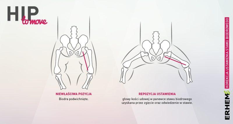 Erhem ERH-662 - Aparat stabilizująco-obwodzący staw biodrowy